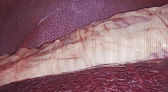 纤维镜去摩尔纹前